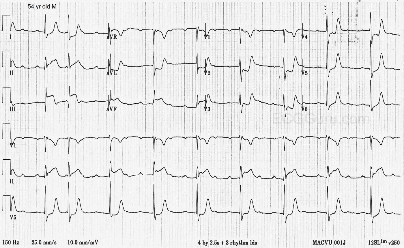 Inferiorposterior Wall M.I. and AV Dissociation ECG Guru